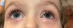 Раздуло глаз у ребенка фото 5