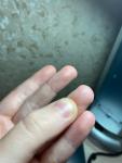 Крапинки и неровности на пальцах фото 5