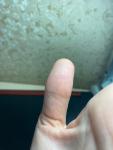 Крапинки и неровности на пальцах фото 4