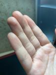 Крапинки и неровности на пальцах фото 3