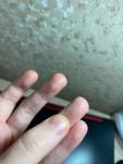 Крапинки и неровности на пальцах фото 2