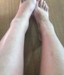 Воспаление коленного сустава фото 2