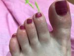 Красные пятна на пальцах ног фото 1