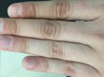 Потемнение кожи пальцев руки фото 1