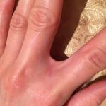 Проблема кожи и ногтей на руке фото 4
