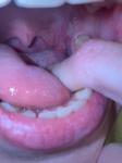 Выпуклость на небной дужке фото 1