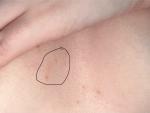 Шелушение на кожи груди фото 1