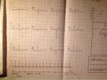 Не понятна ЭКГ. Жалоб нет, иногда бывает усталость фото 3