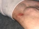 Красное пятно на колене и стопе без зуда фото 2