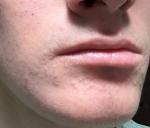 Покраснение и высыпания на лице фото 1