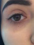 Аллергия, зуд глаз, покраснение фото 1