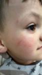 Красные пятна на лице у ребенка лопаются капилляры фото 1