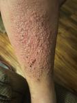 Skin disorder on front lower leg/shin фото 1