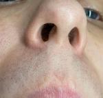 Покраснение и шелушение справа от кончика носа фото 2