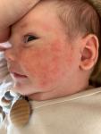 Высыпания на лице у ребенка 1.5 месяца фото 2