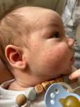 Высыпания на лице у ребенка 1.5 месяца фото 1