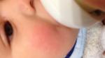 Красные щеки дерматит или алергия? фото 3