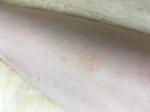 Розовые пятна на ногах (зуд) фото 2