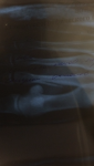 Перелом 2 плюсневой кости фото 2