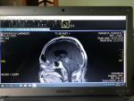 Опухоль в пинеальной области головного мозга, гидроцефалия фото 1