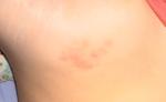 Высыпание. Зуд фото 4