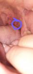 Пузырь в горле около миндалин ближе к зубам фото 1