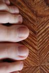 Как лечить грибок ногтевой пластины на ногах фото 1