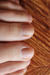 Как лечить грибок ногтевой пластины на ногах фото 2