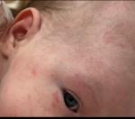 Появились прыщики на лице, голове и за ушкамм фото 1