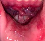 Нарушение функционала нижней губы после аварии фото 2