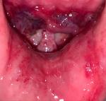 Нарушение функционала нижней губы после аварии фото 1