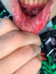 Нарушение функционала нижней губы после аварии фото 3