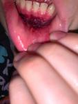 Нарушение функционала нижней губы после аварии фото 4