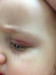 Воспаление глаза на верхнем веке у ребенка фото 3