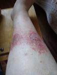 Красные пятна на ногах, не чешутся, лопаются волдыри, мокнет кожа фото 2
