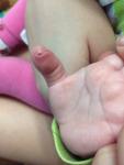 Припухлость на пальце, как прищемили у грудного ребенка фото 1