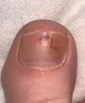 Безболезненные пятна на ногтях фото 1