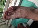 Проблема с пальцами ног. Выделение жидкости и опухание фото 1
