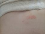 Красное пятно у ребенка шелушащяеся фото 2