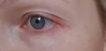 Красные пятна с белыми точками во внешних уголках глаз фото 1