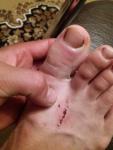 Боль и уплотнение возле ногтя на большом пальце ноги фото 1