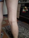 Пятна и жжение ноги фото 2