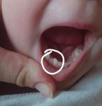 У ребенка в место одного зуба растет два фото 1