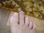 Болит палец ноги фото 1