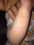 Сыпь на руке ребенка (энтеровирус?) фото 1