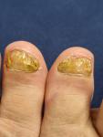 Как вылечить грибок ногтей ног фото 1