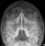 Описание рентгеновского снимка придаточных пазух носа фото 1
