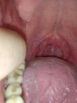 Опухоль на горле в рту фото 1