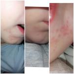Пероральный дерматит у ребенка 2 года фото 1