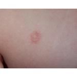 Пероральный дерматит у ребенка 2 года фото 2